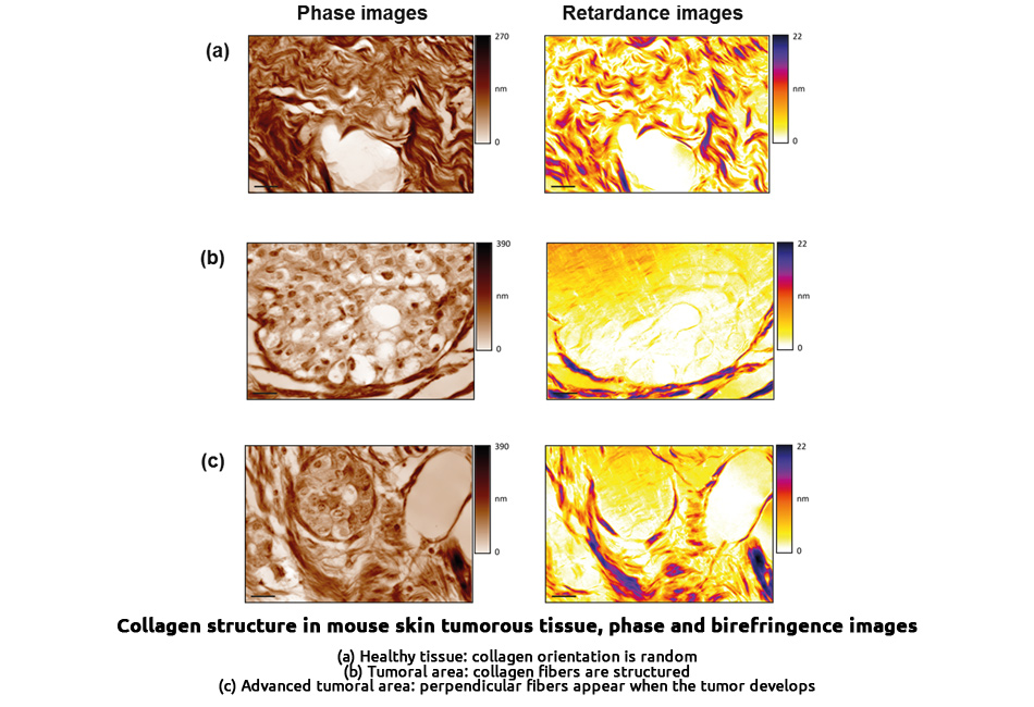 structure-observation-collagen-tumor